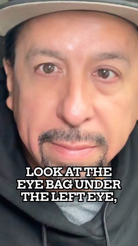 Watch Eye Bags Disappear with Instant Firming Cream!