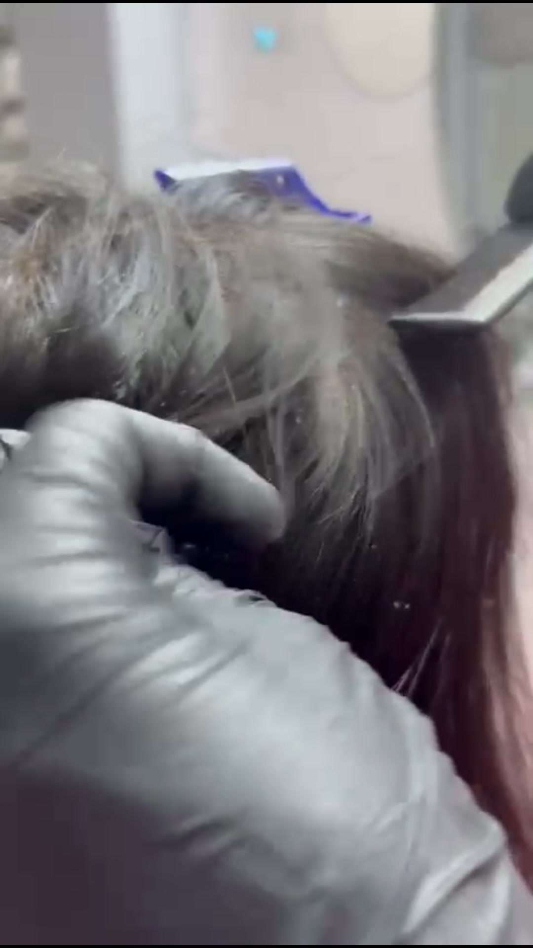 डैंड्रफ का सटीक इलाज: स्कैल्प एनालिसिस और एंटी-फंगल थैरेपी